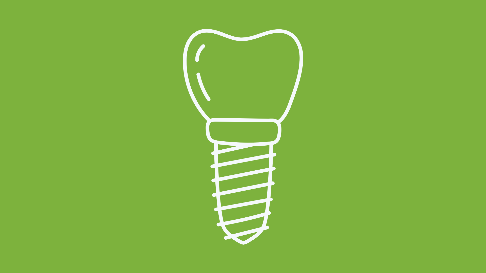 Computer Planned Dental Implants